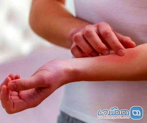 بهترین راهها برای از بین بردن جای نیش حشره