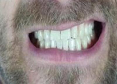 با این روش ها دندان قروچه را درمان کنید