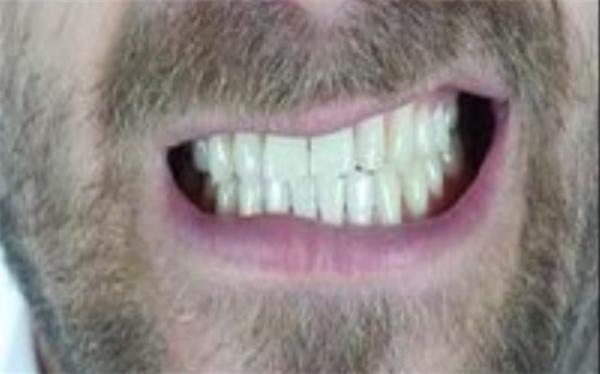 با این روش ها دندان قروچه را درمان کنید
